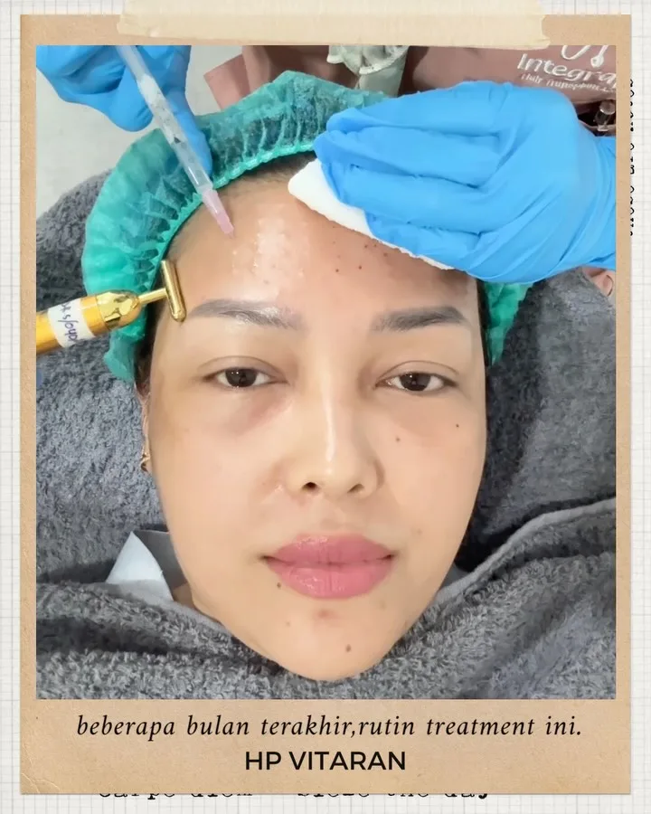 Skin diary — 3 bulan terakhir gue lagi rutin HP Vitaran, treatment… — 2/4